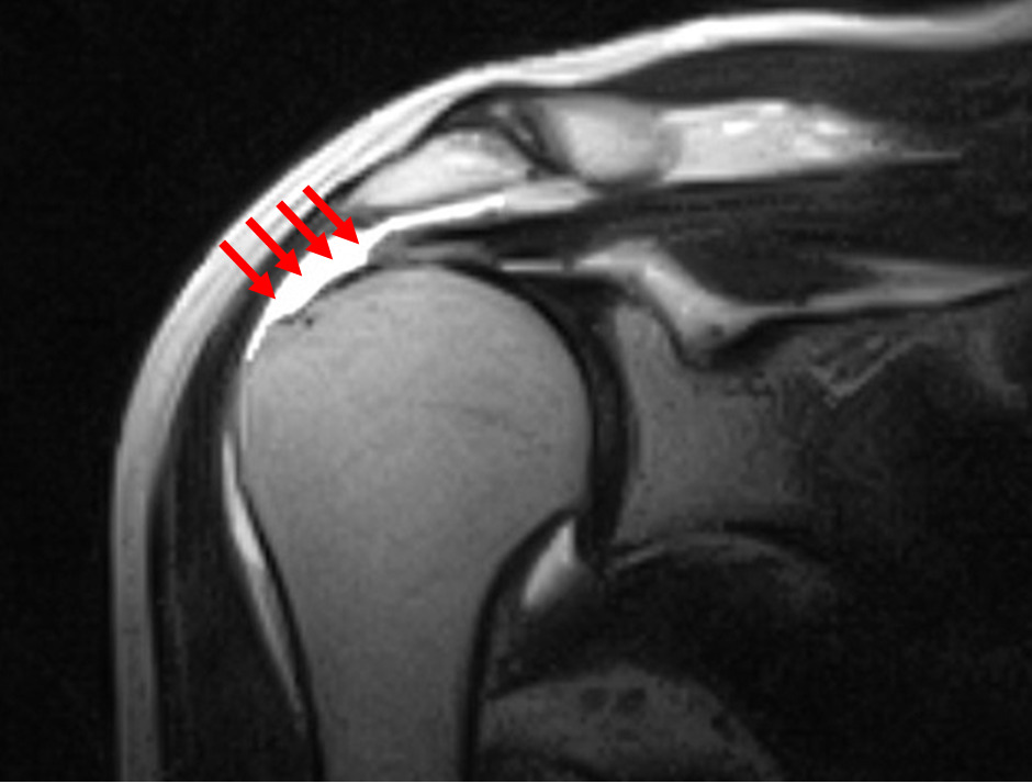 腱板断裂のMRI画像